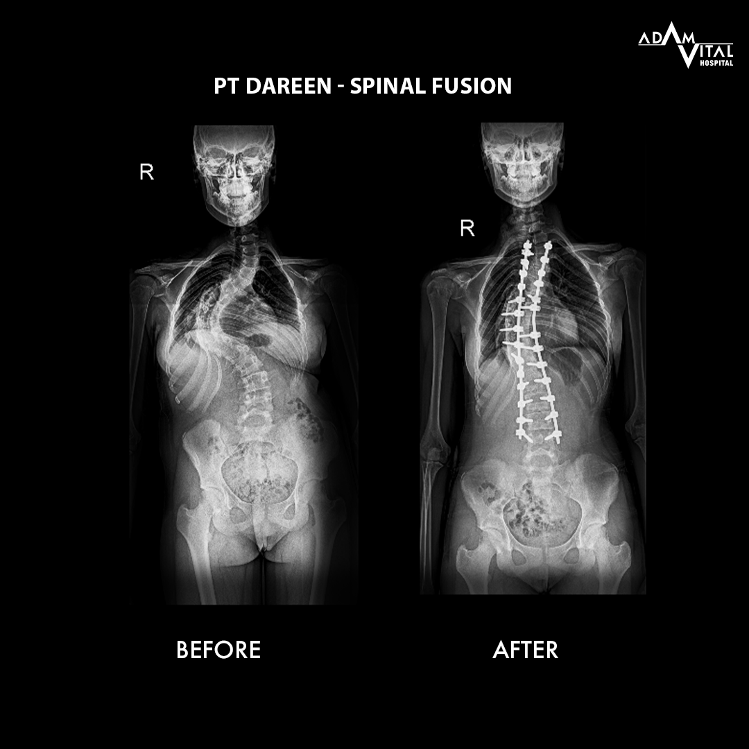 Age-Related Kyphosis