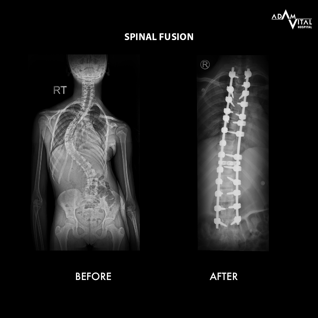 Age-Related Kyphosis