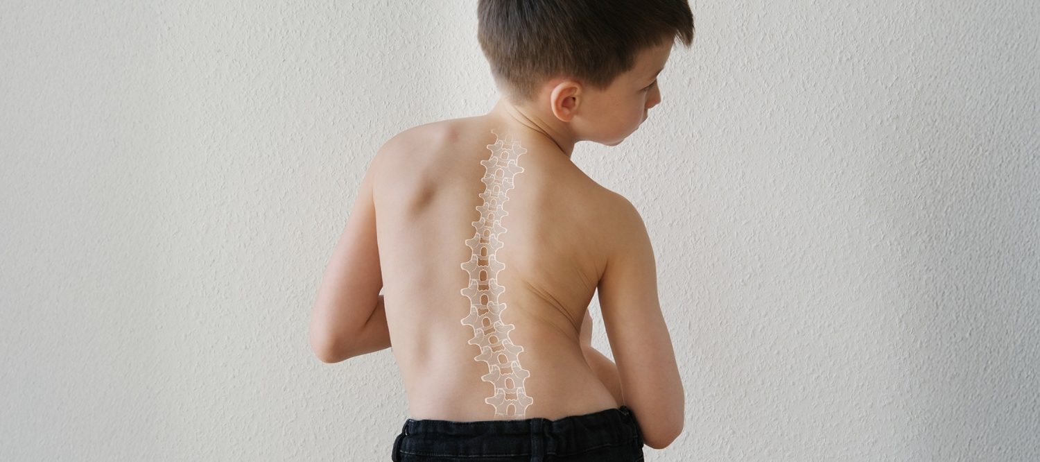 child having mild scoliosis