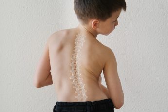 child having mild scoliosis