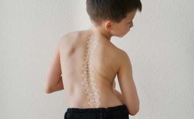 child having mild scoliosis