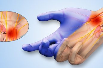 carpal tunnel syndrome