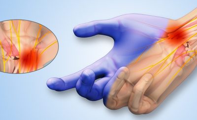 carpal tunnel syndrome