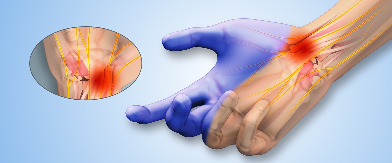 carpal tunnel syndrome