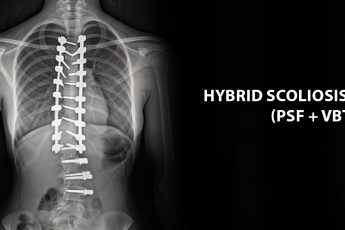 Hybrid-Scoliosis-Surgery