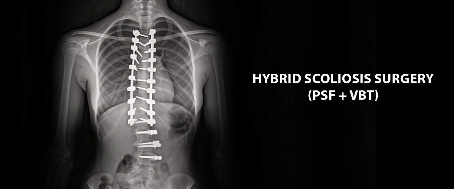 Hybrid-Scoliosis-Surgery