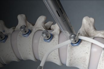 Vertebral Body Tethering (VBT)