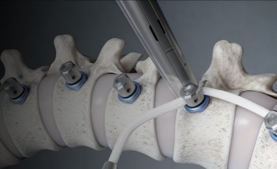 Vertebral Body Tethering (VBT)