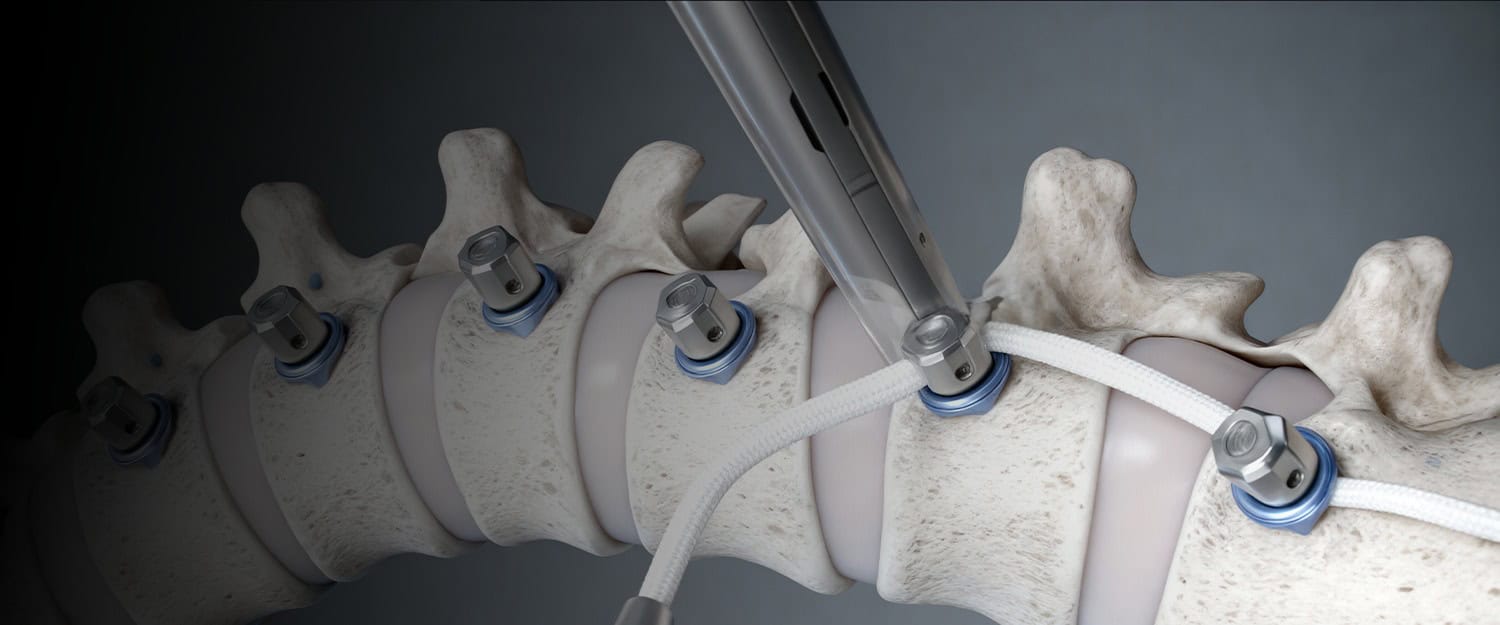 Vertebral Body Tethering (VBT)